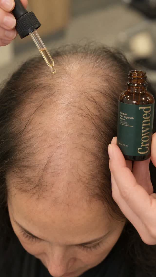 Person applying hair serum from a dropper to a thinning scalp area